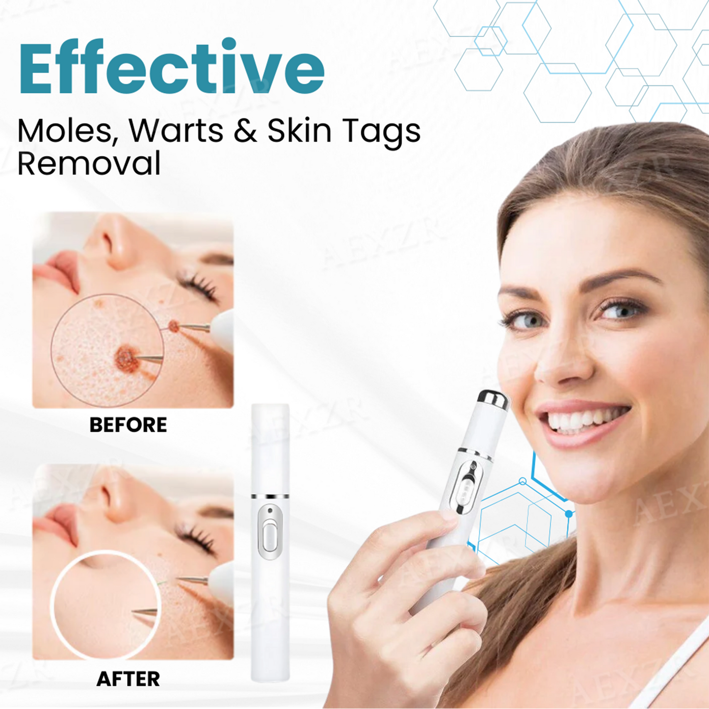 ODALIT™ Non-Invasive Mole and Wart Removal Laser Pen
